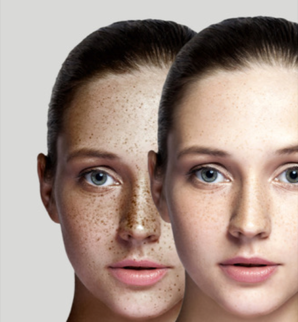 Meline – peeling ved pigmenteringer